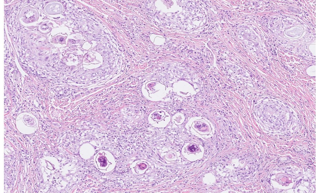 Numerous trematode ova surrounded by granulomatous inflammation and fibrous connective tissue in the deep muscular layers of a dog.