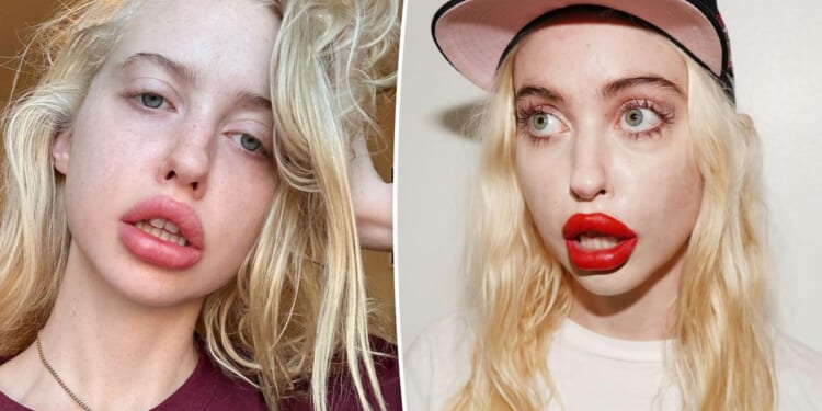 'Euphoria' star Chloe Cherry says she’s gotten so much lip filler, she doesn’t need numbing cream